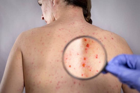 severe symptoms shingles